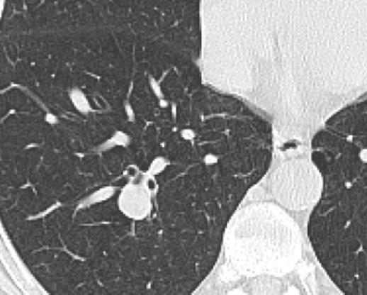 Pulmonaalhüpertensiooni tunnused CT uuringul Segmendiarteri läbimõõdu suhe saatva bronhi diameetrisse >1,25: spetsiifilisus >90%, tundlikkus 70% Kopsuparenhüümi