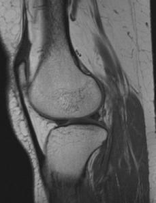 Imagini IRM ce permit vizualizarea cartilajului femural, in secvente T1, respectiv T2 Valorile pentru grosimea cartilajului identificate prin IRM s-au corelat cu cele identifcate prin US mai ales