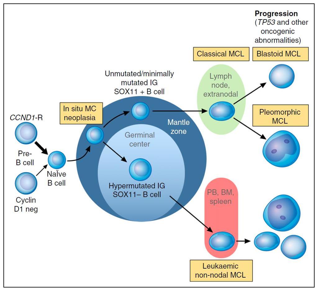 Lymfóm z plášťových buniek (MCL) 2 cesty patogenézy: a.) nemutované IGVH, SOX-11+ b.