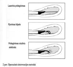 1 pav. Histeroskopijos atlikimas. 2 pav. Operacinės intervencijos metodai. Ten, kur nėra valios, nėra ir kelio.