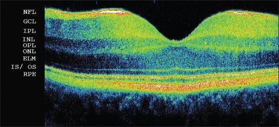 унутрашњи мрежасти слој (IPL-inner plexiform layer); слој ганглијских ћелија (GCL- ganglion cell layer); унутрашња гранична мембрана/слој нервних влакана (ILM/INFLinternal limiting membrane/nerve