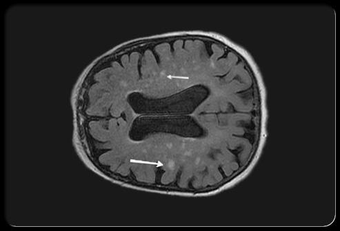 Vaskularna demenca Pričetek povezan z možgansko kapjo (velikokrat brez jasne informacije o preteklih kapeh, muluple majhne ishemične spremembe v možganovini).