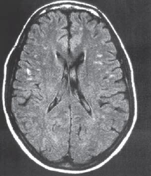 акутните лезии немање на дискретни граници, има среден интензитет на Т2 снимки, имаат елипсоидна форма и се наоѓаат на границата меѓу кортексот и белата маса, или во белата маса.