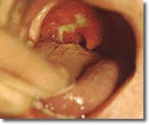 Difteria