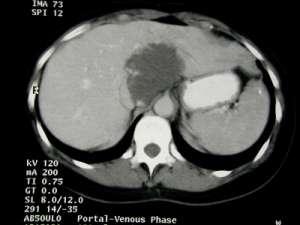 Slika 2.6.2. CT prikaz jetre ( www.emedicine.medscape.com) Slika 2.6.3.