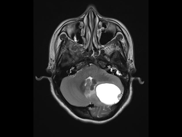 Väikeaju HB[Case courtesy of Dr Subash Thapa, Radiopaedia.