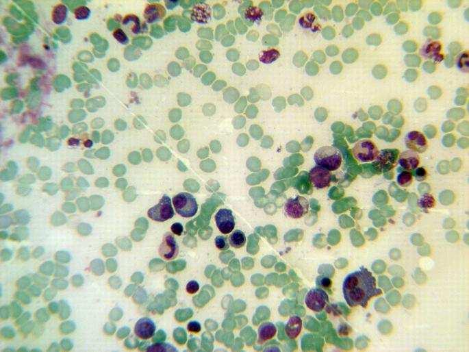 AntiHIV Ab = - Urine protein electerophoresis = normal Lipase = 475 ALB = 4/9 Wright, 2 ME = - PT = 14 PTT = 39 Iron = 60 TIBC = 360 Ferritin = 31 Combs Test (D,IN) = - Retic Count = 0/4 ANA = 0/2 (<