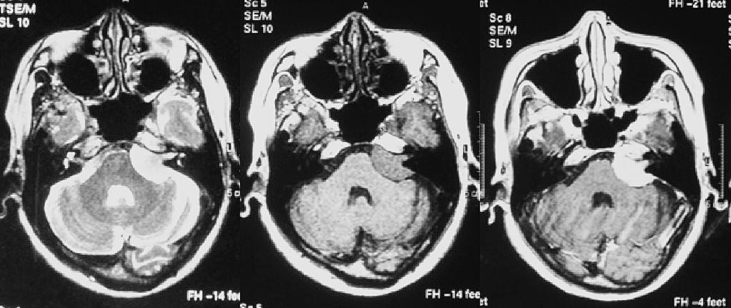547 Fig. 3 56 MRIT2 T1 Simpson grade 2 1990 19 mortality morbidity 20 Linsky 20 14 38 7.85 cm 3 GKS 21.5 96.