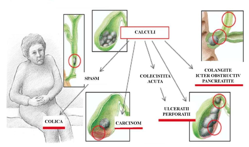 Fig. 9. Consecinţele litiazei biliare a.