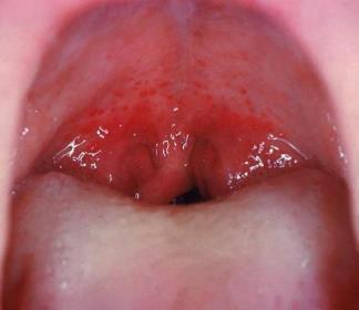 streptococică, limfadenită tonsilita streptococică cu