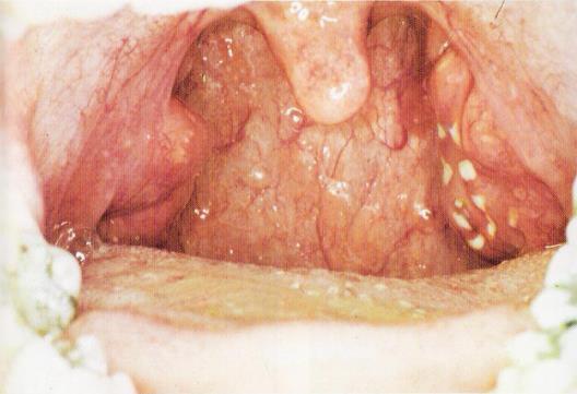 cât streptococul este prezent în nas, faringe, pe