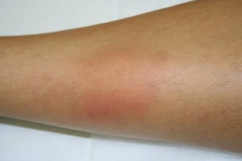 Erythema nodosum 19-aastane