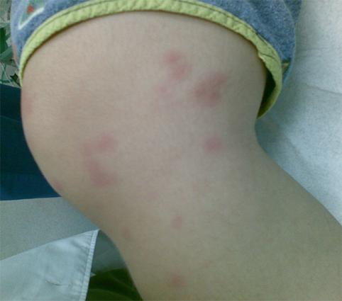 Erythema nodosum Äge sarkoidoos: