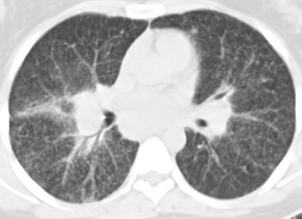 II staadiumi sarkoidoos Sama 19-aastane naispatsient: CT uuring samal ajal - näha peamiselt mõnemillimeetrise läbimõõduga sõlmekesi, mis vastavad sarkoidoosispetsiifiliste granuloomide