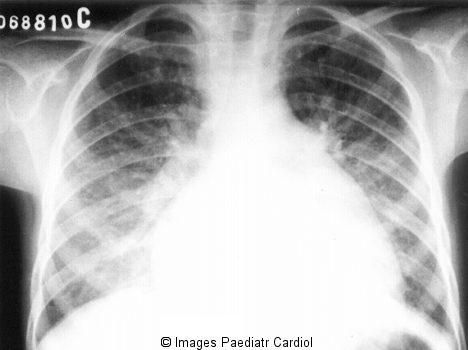 EKG: modif nespecifice: tulburari de ritm si conducere, modificari de faza terminala, BAV gri Ecocardiograma: evidentiaza prezenta pericarditei, dilatarii