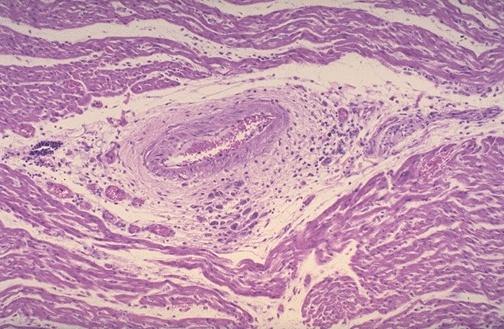 Leziunile fundamentale: Lez inflamatorii Morfopatologie Lezexudativ-degenerative (degenerescentamucoida si fibrinoida): constau in tumefactia si fragmentarea fibrelor de colagen, edemul mucoid