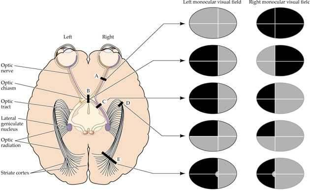 monookulare shakaktohen nga lezionet unilaterale të retinës ose nga lezionet parciale të nervit optik, ndërsa ato binokulare nga lezionet unilaterale të rrugës vizive nga kiazma optike e tutje.