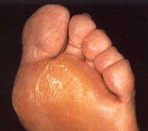 Callosities 1) Off-loading 2) Callus removal 3) Reduction of skin