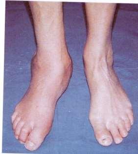 A patient with long-standing diabetes attends the foot clinic
