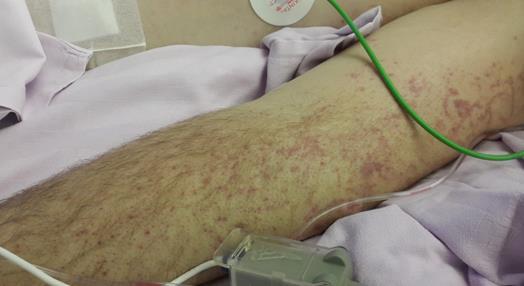 3.-5. klinični primeri KRIOGLOBULINEMIČNI VASKULITIS Nov 2016: 45 let, metadon, 14 let poznan HCV (CIT UKC) zavrača zdravljenje HCV krioglobulinemičen vaskulitis, ALO (HD) nekrozantni fasciitis UMRL
