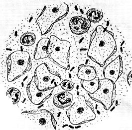 Antrasis makšties švarumo laipsnis. Normali lytinių takų būklė. Randama įvairesnė saprofitinė mikroflora, be laktobacilų yra Commavariabile bakterijų, pavienių leukocitų, epitelinių ląstelių. 5 pav.