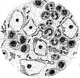 Patologinė lytinių takų būklė: saprofitinės mikrofloros beveik nėra, daug epitelinių ląstelių, leukocitų, kokinė mikroflora. 6 pav.
