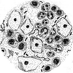 Patologinė lytinių takų būklė: saprofitinės makšties mikrofloros nėra, mažai epitelinių ląstelių, gausu leukocitų, randama sarcinų, streptokokų, trichomonų. 7 pav.