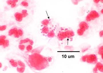 11 pav. Gonokokai leukocito viduje (Bottone, 2006) Mikroskopija. Tiriamosios medžiagos tepinėlis dažomas Gramo būdu. Pirmasis diagnostikos etapas bakterinei vaginozei diagnozuoti yra tepinėlis.