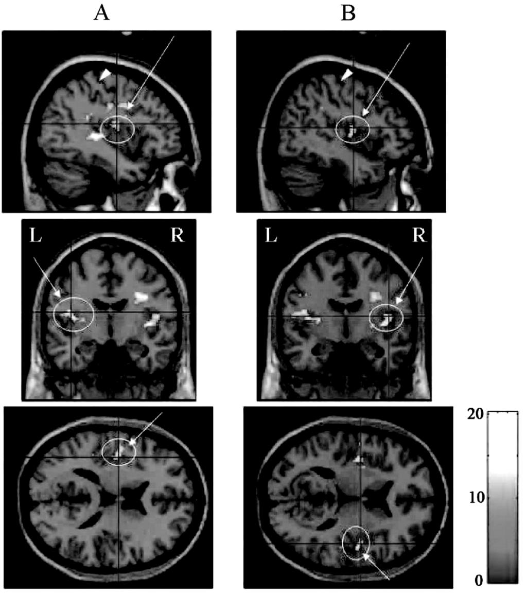 404-1 0 +2 PET : positron emission tomography fmri : functional Magnetic Resonance Imaging,3 -+.1* G -,, MEG G.- fmri G.- -- 1 G.- P + +,0.1 ms N +,0,.