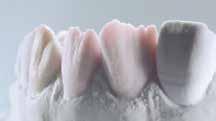 plastenja Deep Dentin