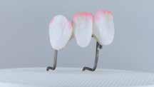 dentina/incizalnega