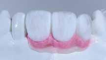Intensive Gingiva (IG2)