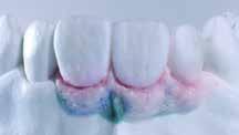 G5) Basic Gingiva (BG34)