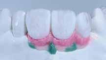 dentina/incizalnega