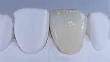 Occlusal Dentin Po peka