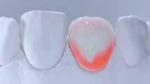 Dentin, Mamelon, Opal Effect,