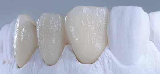 plastenja Deep Dentin