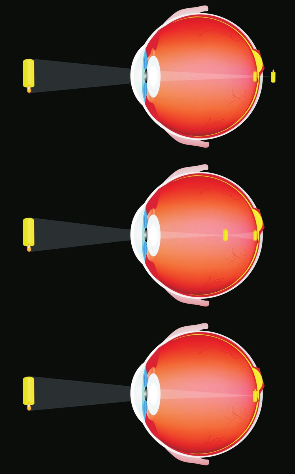 11.3 Optički nedostaci oka Kod normalno grad enog oka, žiža očnog sočiva nalazi se u mrežnjači, tačnije u žutoj mrlji.