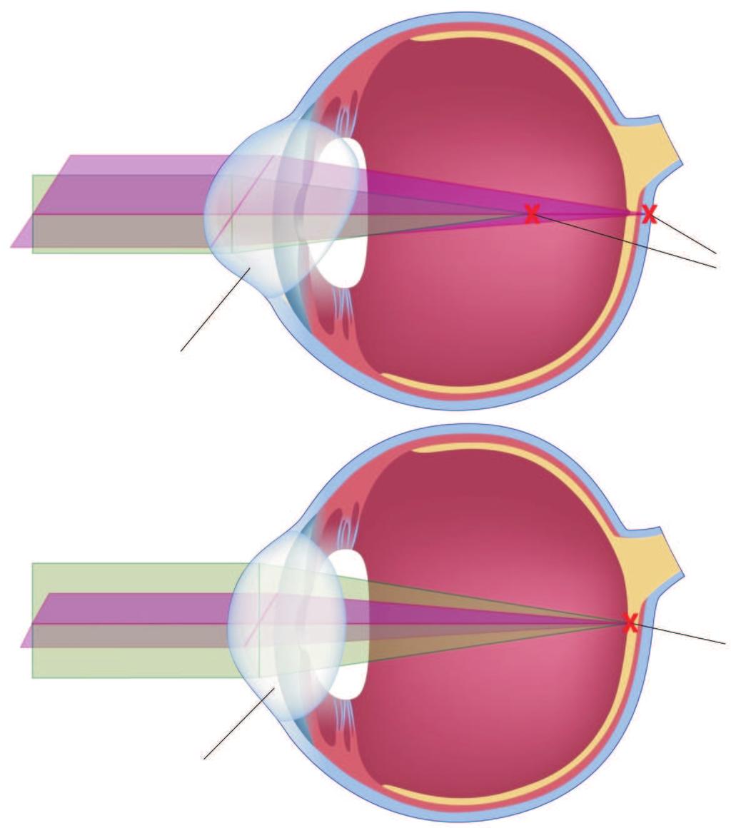 ne postoji, dok je najbliža tačka udaljena od oka u odnosu na slučaj kod osobe normalnog vida približno za 40 60cm.