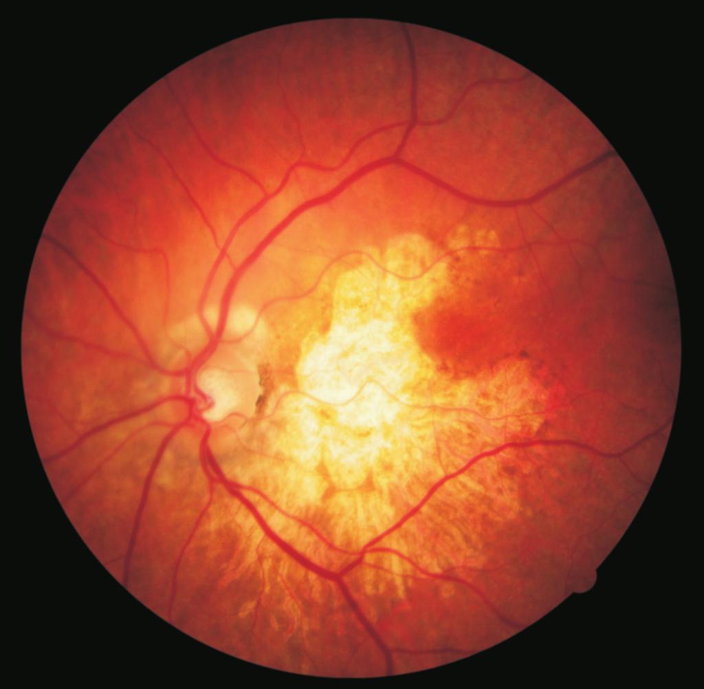 Glava optičkog nerva Makula Slika 75: Mrežnjača Krvni sudovi Mrežnjača (retina) je omotač koji oblaže unutrašnju površinu oka, radijusa oko 40 mm, na kojem se stvara slika.