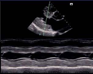 Ehokardiografija intercostalnim skenovima B "brightnes" - mode dijametar srčanih šupljina anatomski