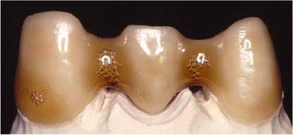 dentin.