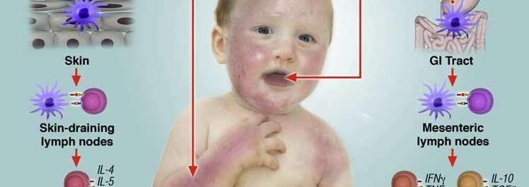allergy. J Allergy Clin Immunol. 2008; 121(6):1331-6.