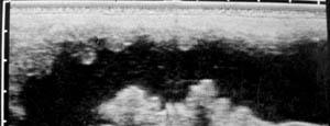 Endometritisi