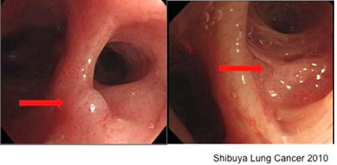 White light bronchoscopy Better image