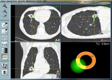 Electromagnetic Navigation Bronchoscopy + EBUS ENB diagnostic yield 63-77 % Independent of lobar