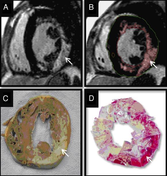 ΥΜΚ - ΤΑΥΤΟΠΟΙΗΣΗ ΙΝΩΣΗΣ (CMR - LGE) O Hanlon et al. JACC 2010 ΕΚΤΑΣΗ ΤΗΣ ΙΝΩΣΗΣ ΣΥΝΔΕΕΤΑΙ ΜΕ ΥΨΗΛΟ ΚΙΝΔΥΝΟ ΑΚΘ, ΚΑ, ΜΕΚΤ Moon et al.