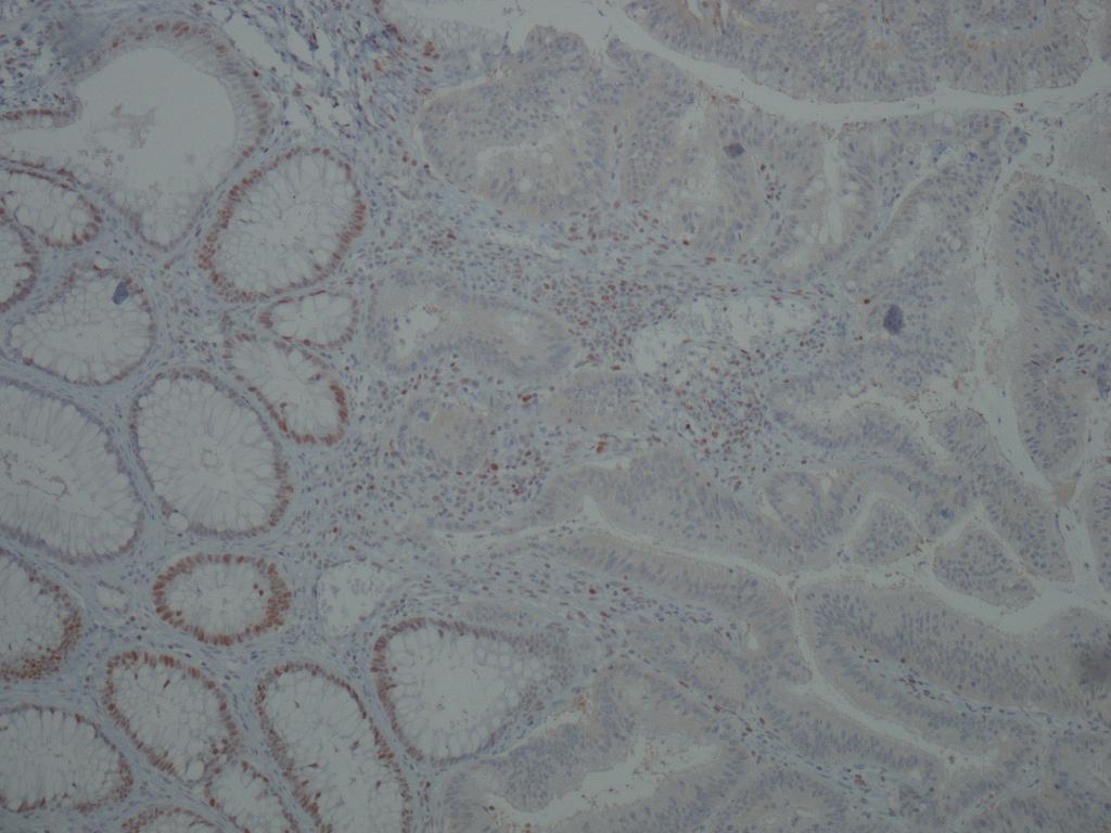 Εικόνα 16Β Εικόνα 17: Απώλεια της έκφρασης της πρωτεΐνης PMS2 σε αδενοκαρκίνωμα