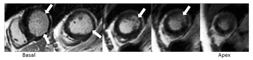 Cardiac MRI Small subendocardial (<25 %) scar in the basal-mid