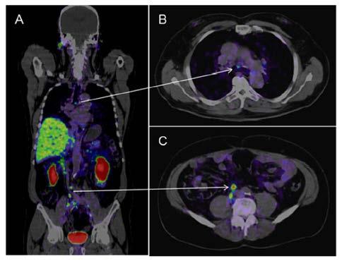 οστών (βασει PSA-επiδείνωσης)/ Bone scan flare 8 12 weeks shows CT (ανά 6 μήνες, αλλά μην